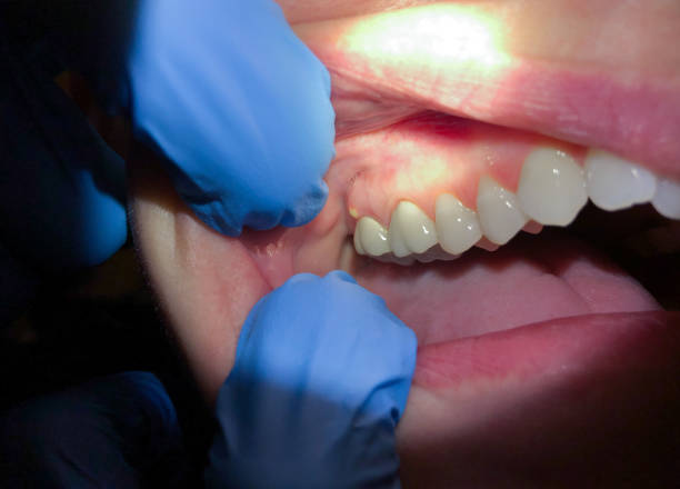 Best Dentist for Tooth Abscess  in Fruitport, MI